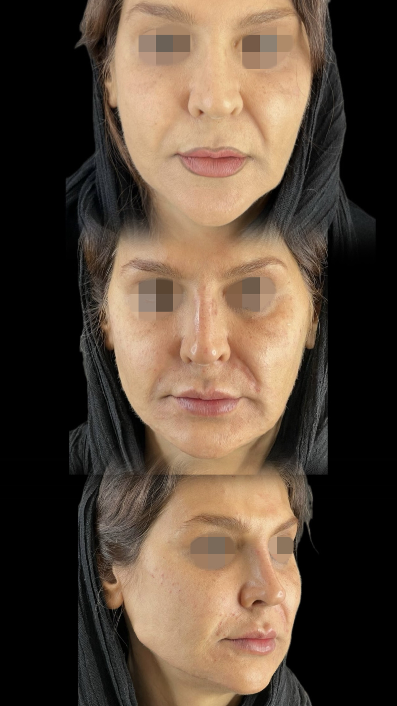 تزریق فیلر فک: راهنمای کامل