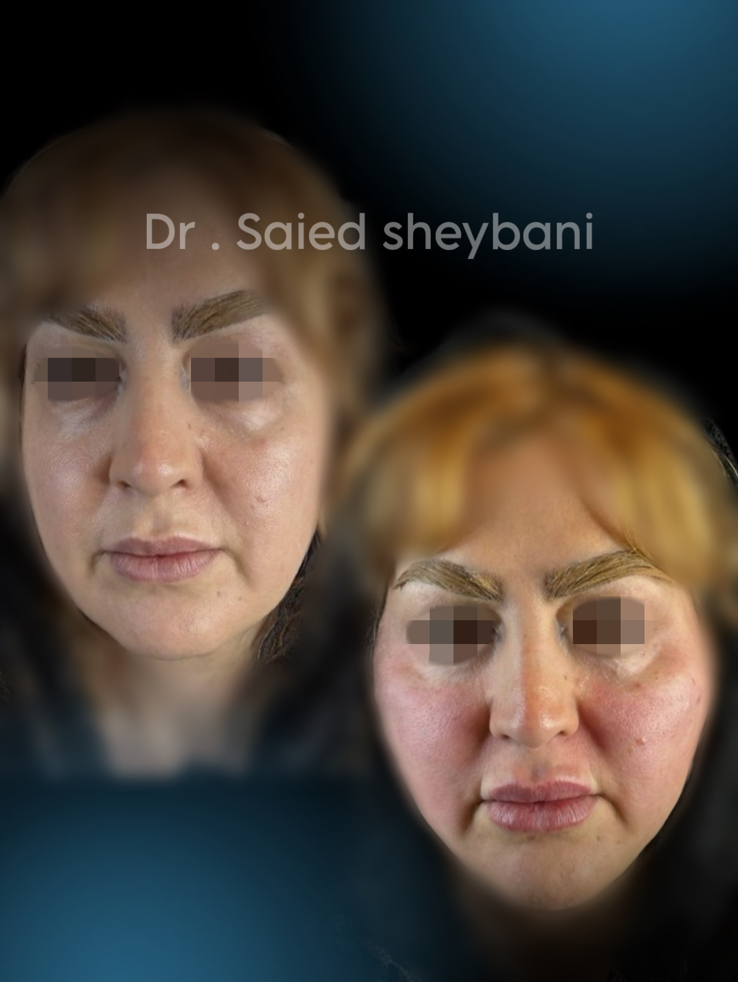 جوانسازی صورت: 10 روش بدون جراحی